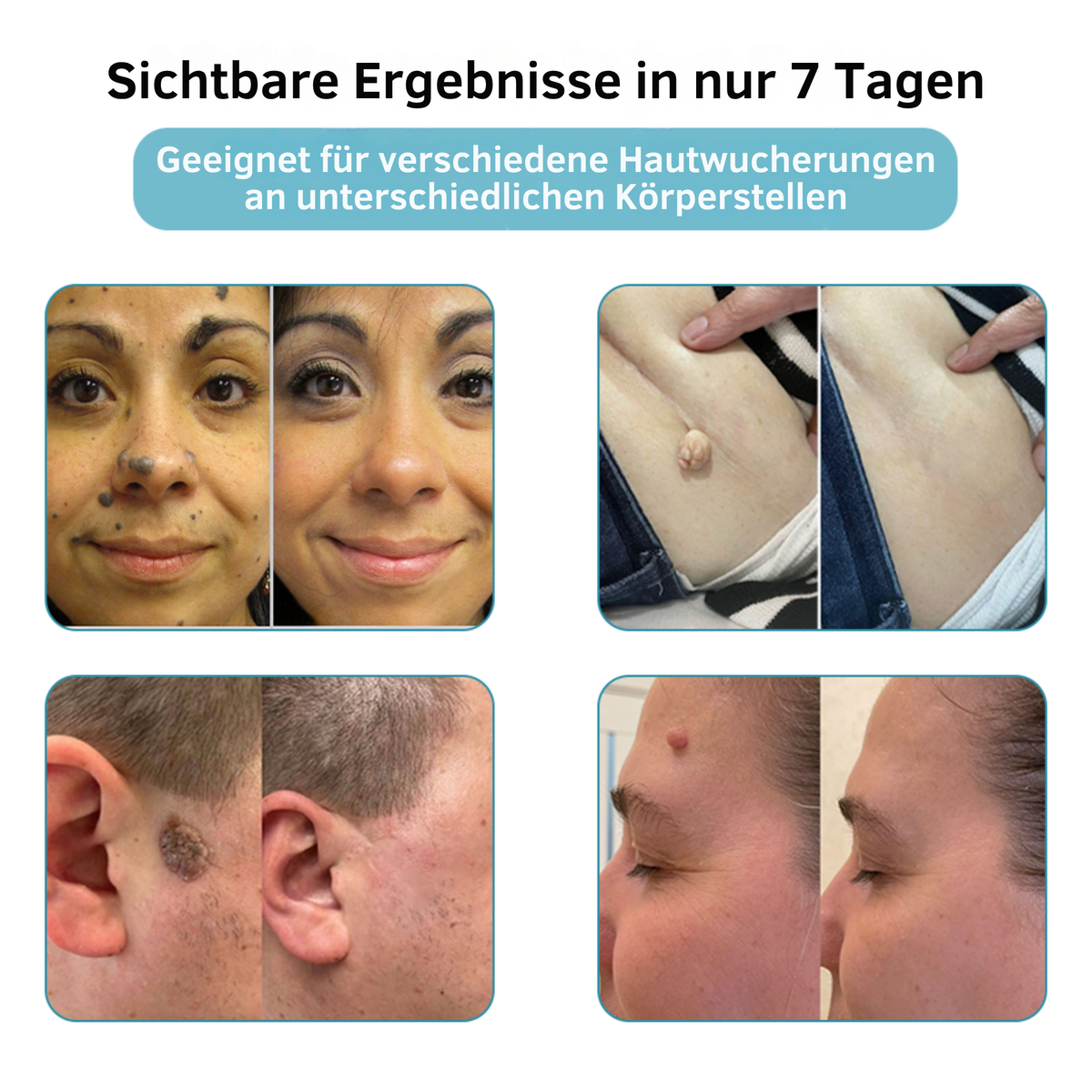 Laserpen til målrettet kosmetisk hudpleje